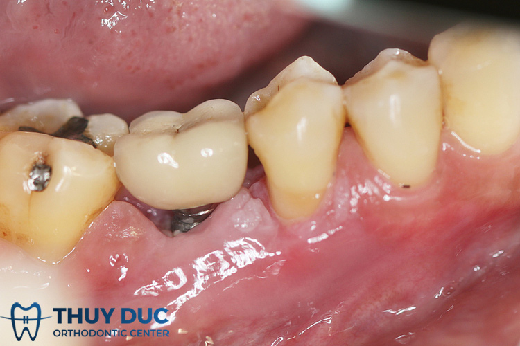 Dấu hiệu nhận biết implant bị đào thải 1 Dấu hiệu nhận biết implant bị đào thải 1