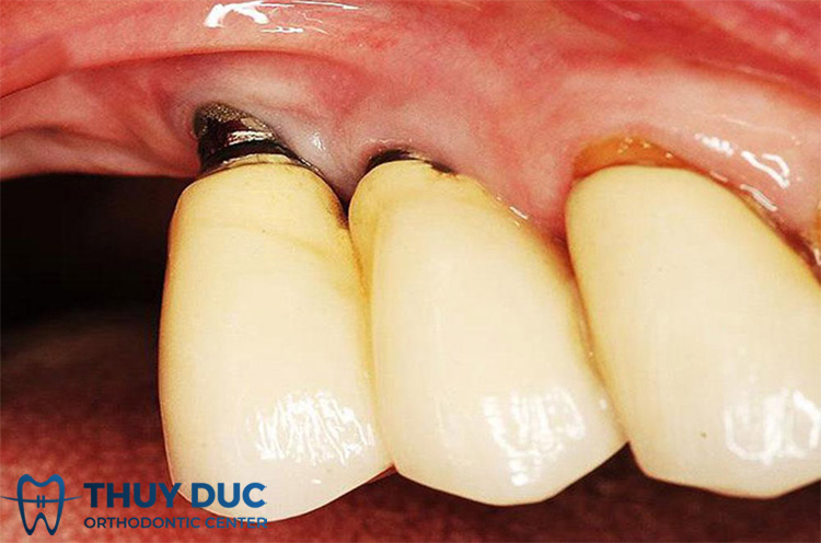 Răng Implant bị đào thải như thế nào? 1 Răng Implant bị đào thải như thế nào? 1