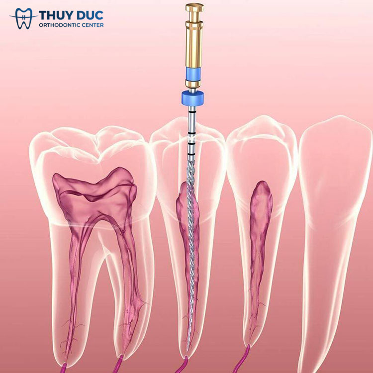 2. Khi nào phải lấy tủy răng? 1 2. Khi nào phải lấy tủy răng? 1