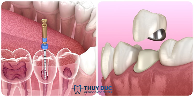 6. Lấy tuỷ bọc răng sứ giá bao nhiêu? 1 6. Lấy tuỷ bọc răng sứ giá bao nhiêu? 1