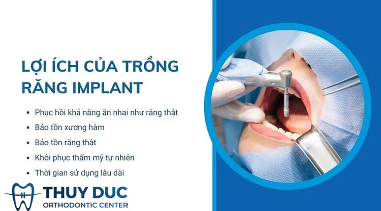 Trồng răng Implant có ảnh hưởng gì không? 1 Trồng răng Implant có ảnh hưởng gì không? 1
