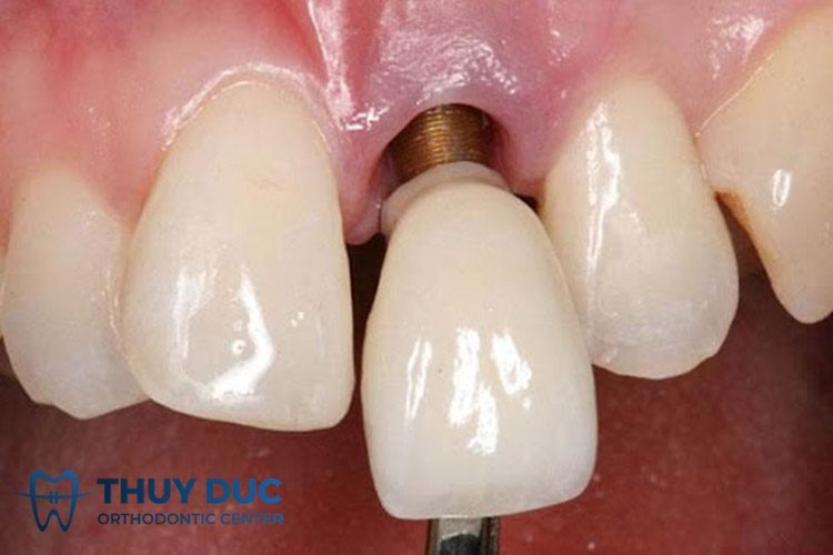 Biến chứng trồng răng implant muộn 1 Biến chứng trồng răng implant muộn 1