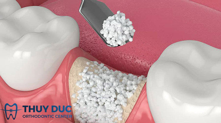 Kỹ thuật ghép xương hàm bằng xương bột 1 Kỹ thuật ghép xương hàm bằng xương bột 1