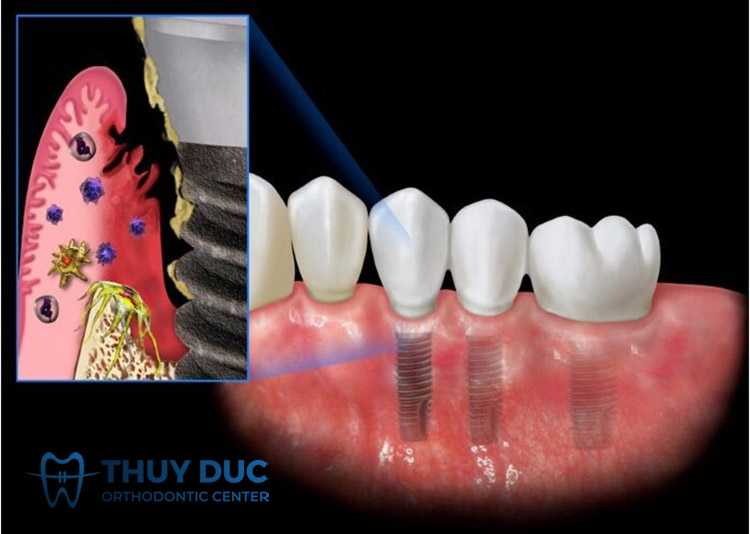Biến chứng ngay sau cấy ghép Implant 1 Biến chứng ngay sau cấy ghép Implant 1