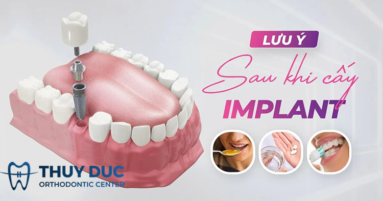 Những lưu ý sau khi trồng răng implant 1 Những lưu ý sau khi trồng răng implant 1