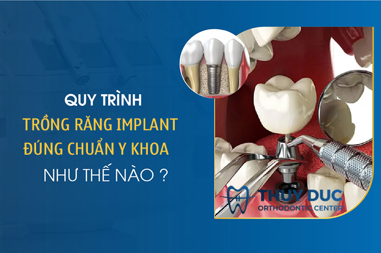 Quy trình trồng răng Implant Đúng Chuẩn Y Khoa 1 Quy trình trồng răng Implant Đúng Chuẩn Y Khoa 1