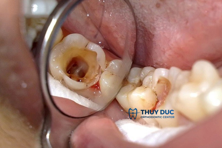 Răng sâu chết tủy là gì? 1 Răng sâu chết tủy là gì? 1