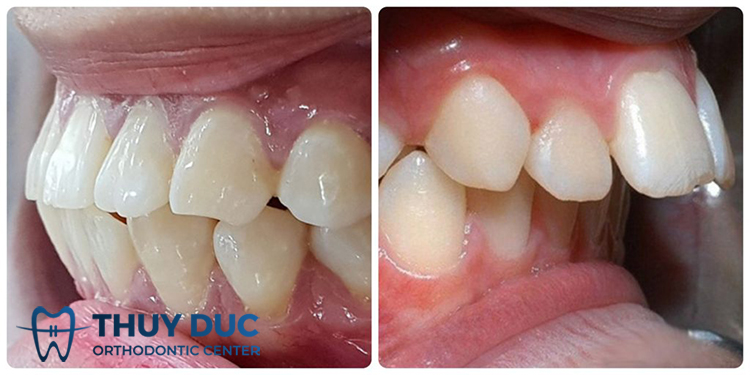 Hàm răng hô là thế nào? 1 Hàm răng hô là thế nào? 1