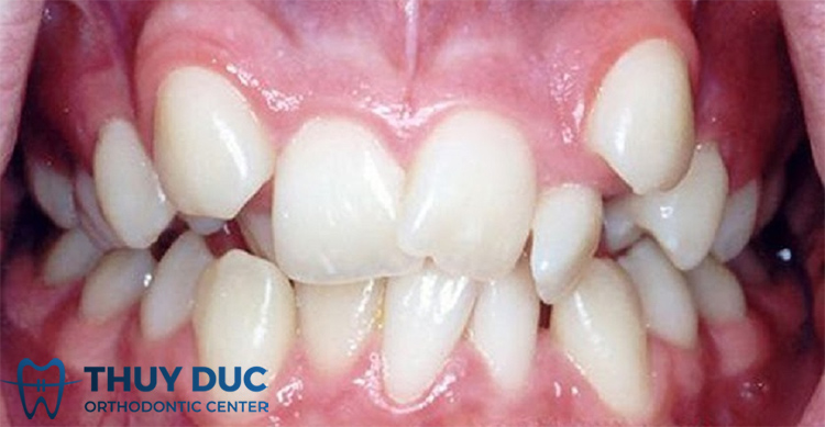 Ảnh hưởng đến thẩm mỹ 1 Ảnh hưởng đến thẩm mỹ 1