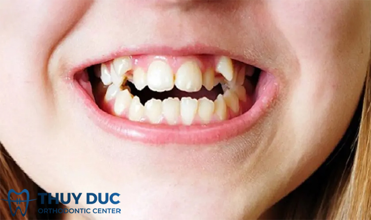 Như thế nào là răng lòi xỉ? 1 Như thế nào là răng lòi xỉ? 1