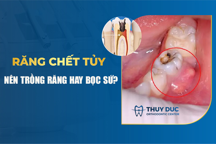 Răng sâu chết tủy nên nhổ răng hay bọc sứ? 1 Răng sâu chết tủy nên nhổ răng hay bọc sứ? 1