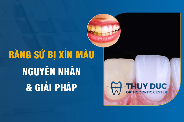 Răng sứ bị xỉn màu - Chỉ điểm các nguyên nhân & biện pháp khắc phục 1 Răng sứ bị xỉn màu - Chỉ điểm các nguyên nhân & biện pháp khắc phục 1