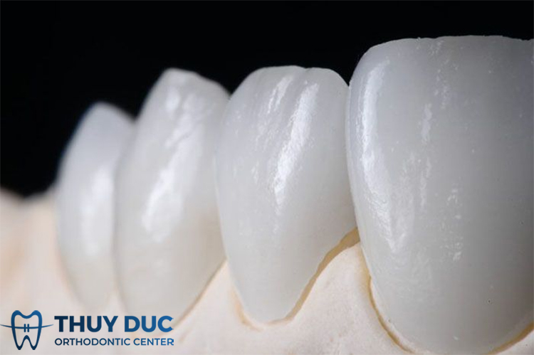 Lựa chọn răng sứ phù hợp cho răng lòi xỉ 1 Lựa chọn răng sứ phù hợp cho răng lòi xỉ 1