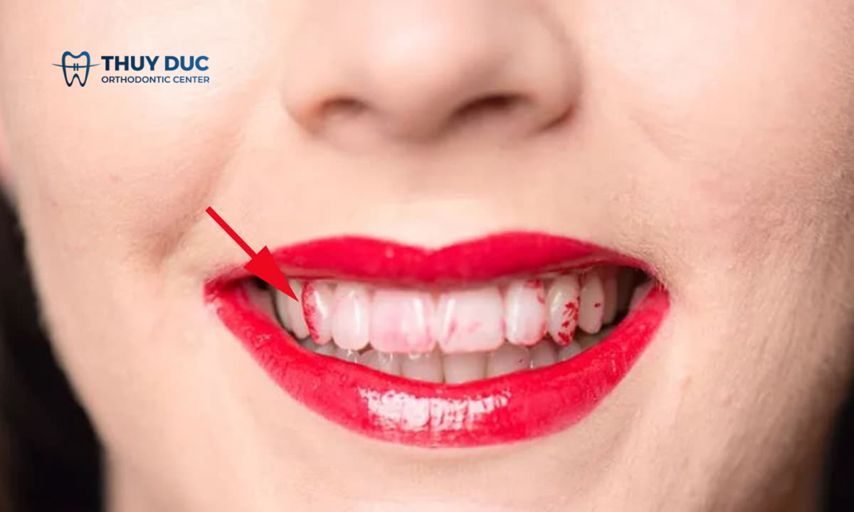 Sau tẩy trắng răng cần kiêng ăn gì? 1