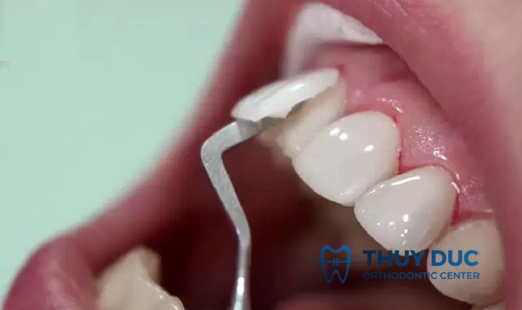 Tháo răng sứ có bị đau không? 1 Tháo răng sứ có bị đau không? 1