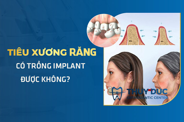 Tiêu xương răng có trồng Implant được không? 1