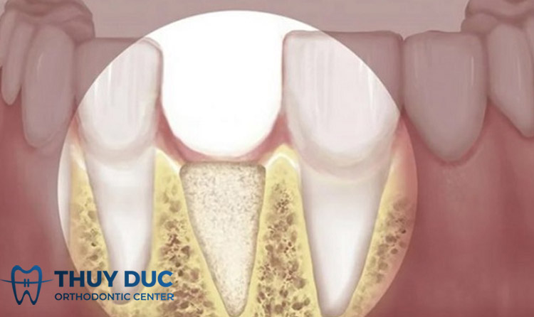 Tiêu xương răng là như thế nào? 1