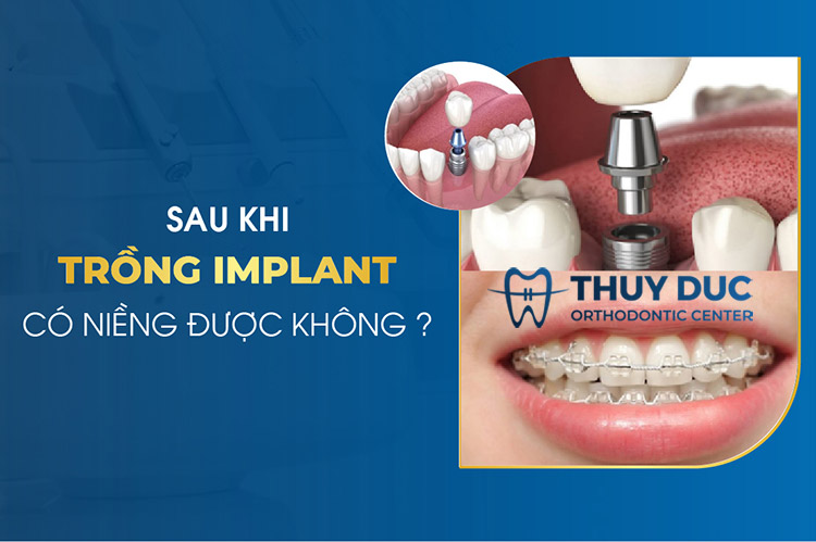 Trồng Implant có thể niềng răng được không? 1
