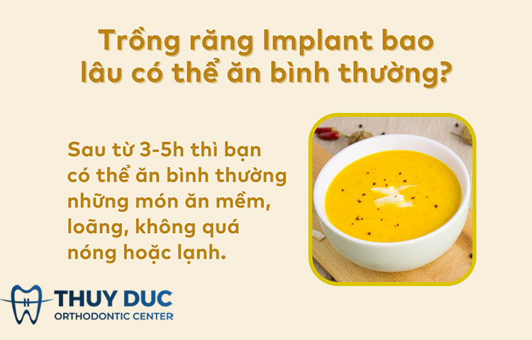 Trồng răng implant sau bao lâu thì ăn uống bình thường? 1 Trồng răng implant sau bao lâu thì ăn uống bình thường? 1