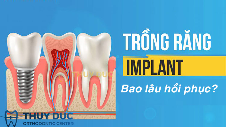 Trồng răng Implant mất bao lâu thì hồi phục hoàn toàn 1 Trồng răng Implant mất bao lâu thì hồi phục hoàn toàn 1