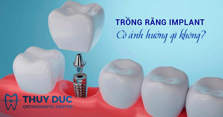 Trồng răng implant có ảnh hưởng gì không? 1 Trồng răng implant có ảnh hưởng gì không? 1