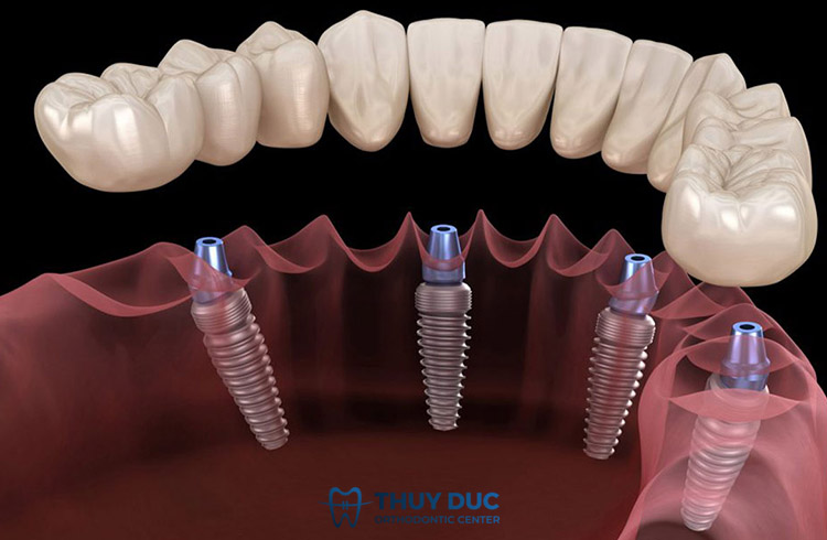 Trồng răng implant có bền không? 1 Trồng răng implant có bền không? 1