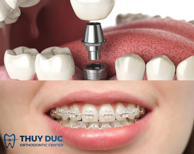 Nên trồng răng Implant trước hay niềng răng trước? 1