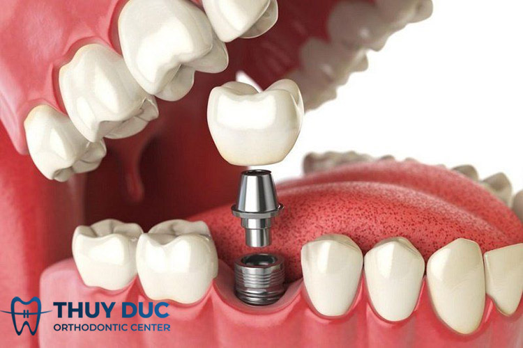 Trồng răng implant mất thời gian bao lâu thì hoàn thiện? 1 Trồng răng implant mất thời gian bao lâu thì hoàn thiện? 1