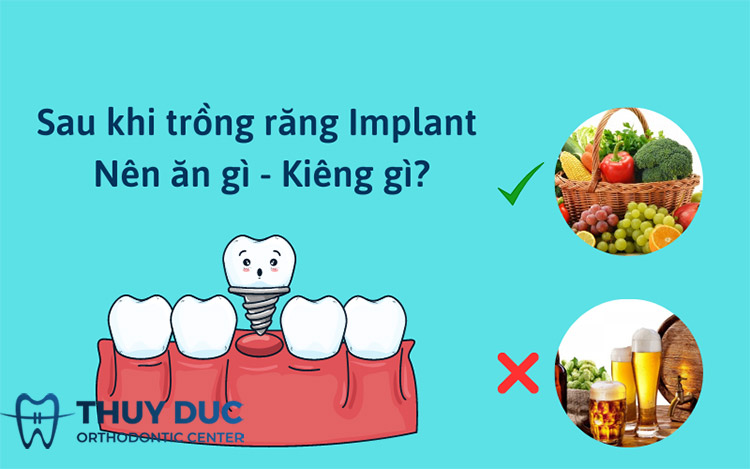 Trồng răng implant nên ăn gì, kiêng gì để nhanh hồi phục? 1 Trồng răng implant nên ăn gì, kiêng gì để nhanh hồi phục? 1