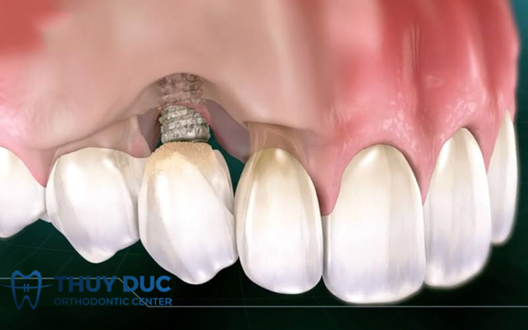 Trụ Implant có thể bị đào thải sau cấy ghép 1