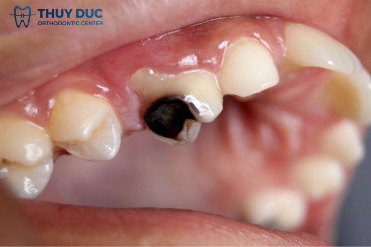 3. Các trường hợp cần lấy tuỷ bọc răng sứ 1 3. Các trường hợp cần lấy tuỷ bọc răng sứ 1