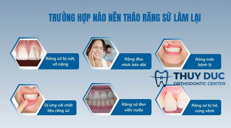 Trường hợp nào cần tháo răng sứ làm lại? 1 Trường hợp nào cần tháo răng sứ làm lại? 1