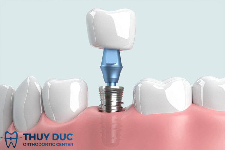 Vai trò của trụ implant trong cấy ghép răng 1 Vai trò của trụ implant trong cấy ghép răng 1