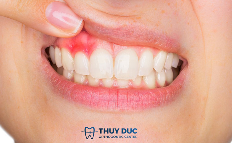 Ưu, nhược điểm của miếng dán trắng răng 1 Ưu, nhược điểm của miếng dán trắng răng 1