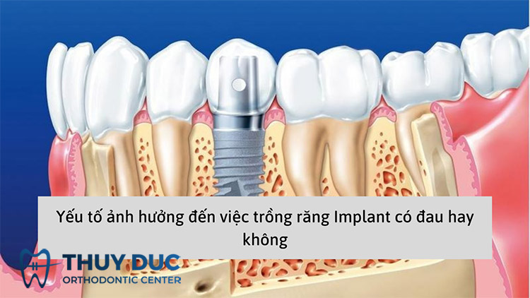 Yếu tố ảnh hưởng đến mức độ đau sau khi cấy ghép Implant 1 Yếu tố ảnh hưởng đến mức độ đau sau khi cấy ghép Implant 1