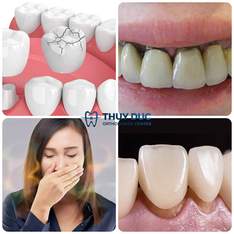 2. Những ảnh hưởng của bọc răng sứ giá rẻ 1