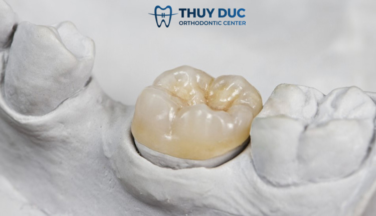 1. Bọc răng sứ giá rẻ là gì? 1