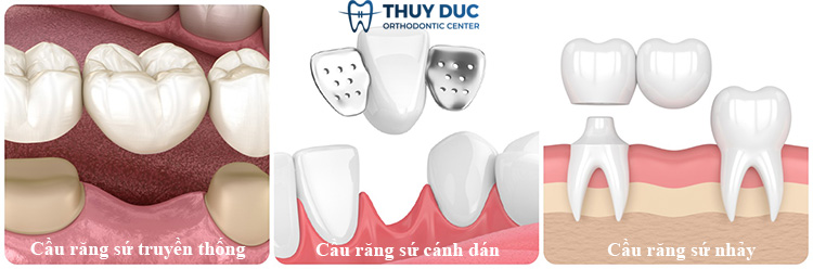 2. Các loại trồng răng sứ bắc cầu hiện nay 1