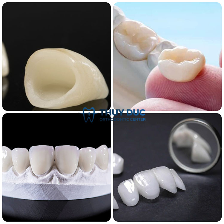 7. Các sản phẩm thay thế răng sứ Inox thẩm mỹ, chất lượng 1 7. Các sản phẩm thay thế răng sứ Inox thẩm mỹ, chất lượng 1