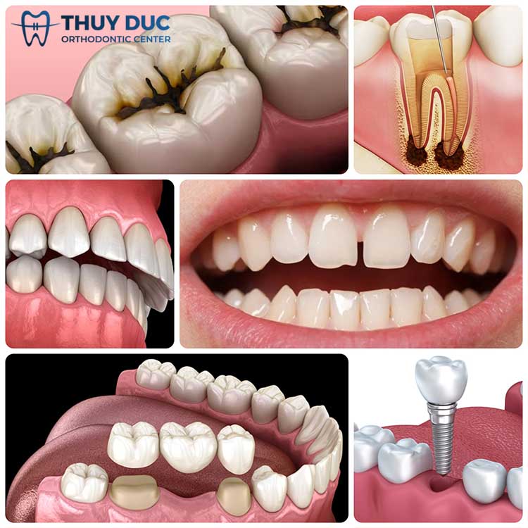 3. Những trường hợp nên bọc răng sứ Venus 1 3. Những trường hợp nên bọc răng sứ Venus 1