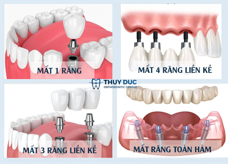 Trường hợp phù hợp với trồng răng implant 1 Trường hợp phù hợp với trồng răng implant 1