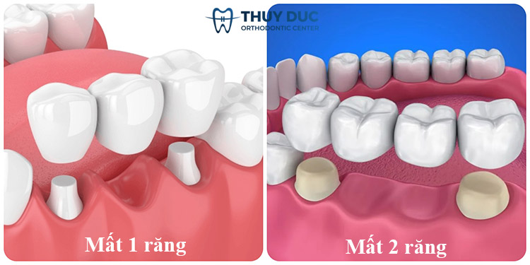 Trường hợp phù hợp với cầu răng sứ 1 Trường hợp phù hợp với cầu răng sứ 1