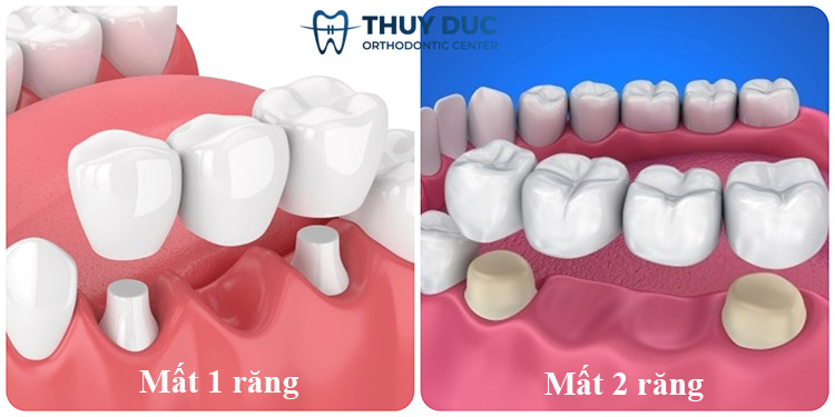 5. Những trường hợp nên trồng răng sứ bắc cầu 1