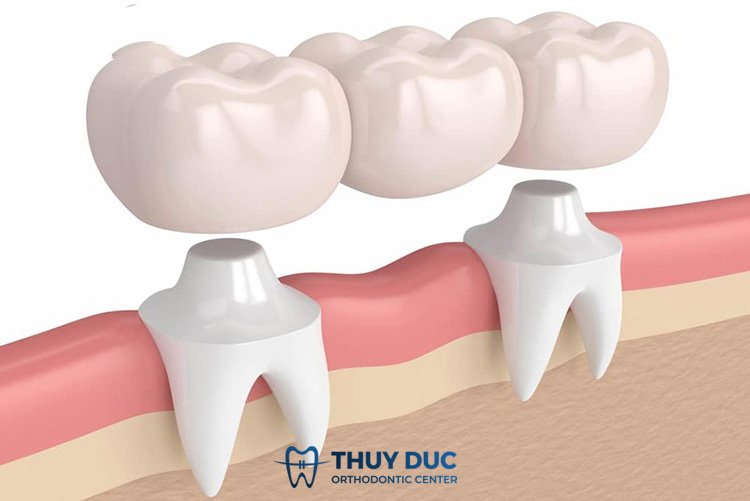 2. Làm cầu răng sứ là gì? 1 2. Làm cầu răng sứ là gì? 1