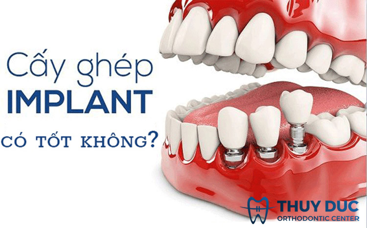 Trồng răng Implant có tốt không? 1