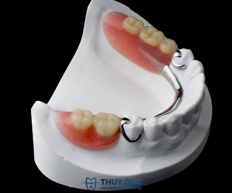 Hàm giả tháo lắp bằng khung kim loại 1