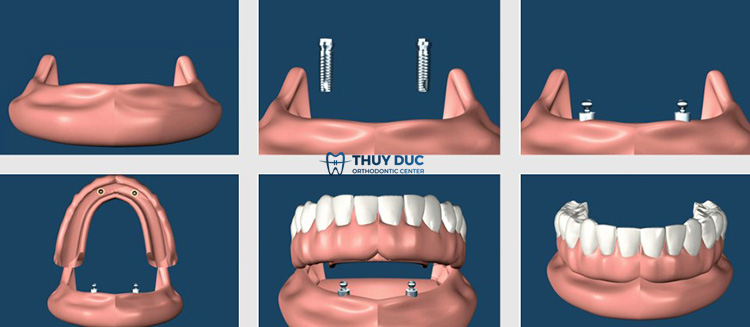 Hàm giả tháo lắp trên implant 1 Hàm giả tháo lắp trên implant 1