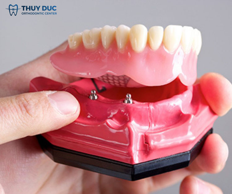 Răng giả tháo lắp trên trụ implant 1