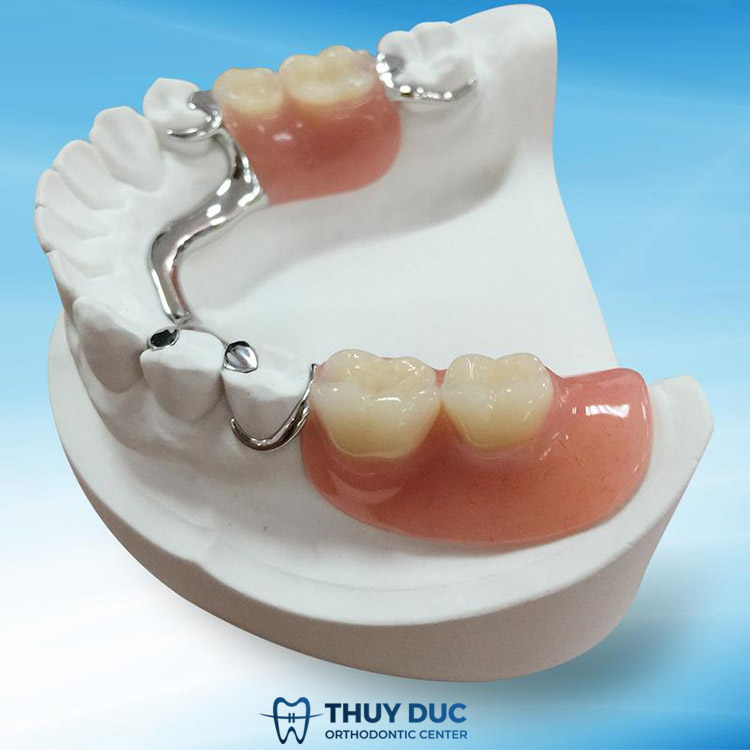 Hàm giả tháo lắp trên khung kim loại 1 Hàm giả tháo lắp trên khung kim loại 1