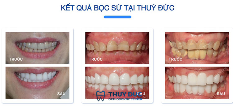 Hình ảnh trước- sau của khách hàng khi bọc răng sứ 1 Hình ảnh trước- sau của khách hàng khi bọc răng sứ 1